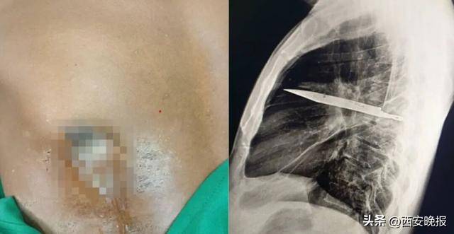 皇冠登3管理出租_罕见！坦桑尼亚44岁男子胸口流脓发出恶臭皇冠登3管理出租，照X光才发现有把刀在体内长达8年，刚好避开心脏血管